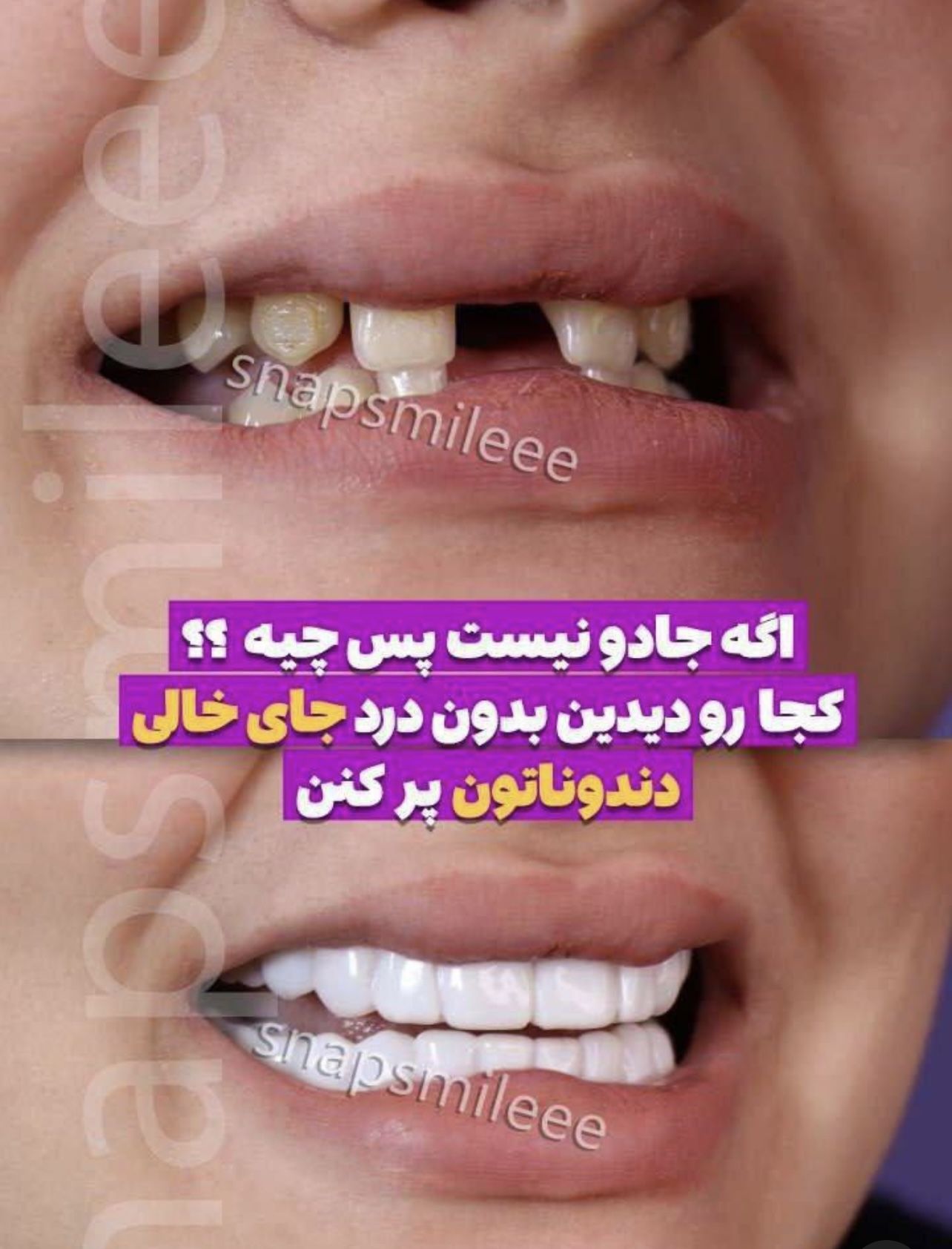  لمینت دندان دو فک اصلی همراه اسباب بازی رایگان جایزه